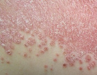 牛皮癬洗發(fā)方法